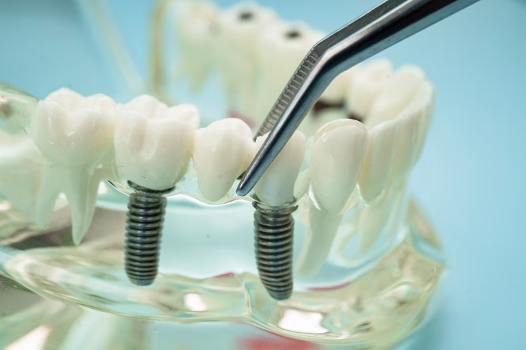 Implant dentar după infarct sau AVC: reguli pentru pacienții cardiaci