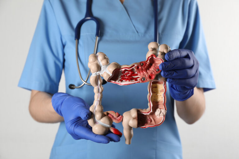 Cancerul de colon, cel mai mortal la persoanele sub 50 de ani